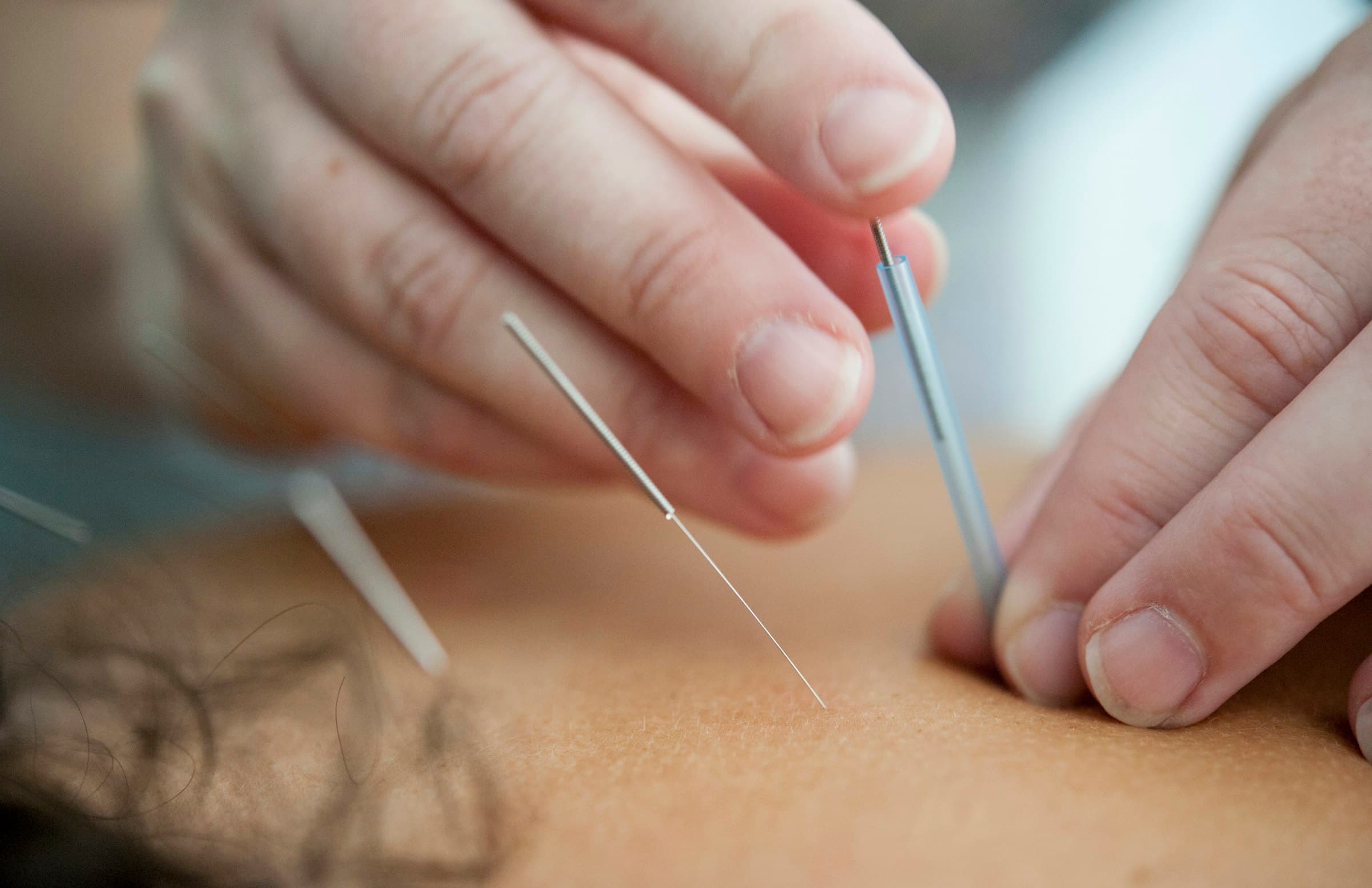 A practitioner placing fine acupuncture needles along a client’s back